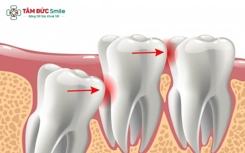 Tùy vào hướng mọc và sức khỏe của răng khôn mà bác sĩ sẽ chỉ định nên theo dõi thêm hay thực hiện thủ thuật nhổ bỏ.