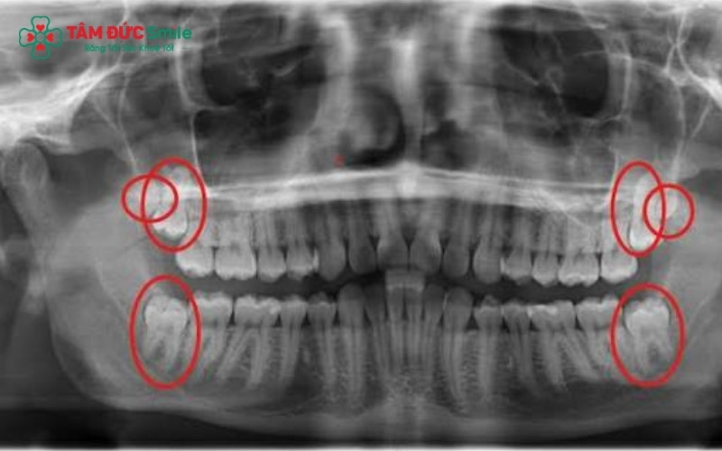 Răng khôn mọc lệch đâm vào răng số 7 không chỉ gây đau nhức mà còn tiềm ẩn nguy cơ gây sâu răng và tiêu xương hàm nếu không được xử lý kịp thời.