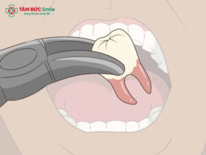 Mọc 4 răng khôn cùng lúc có sao không? Khi nào nên nhổ?
