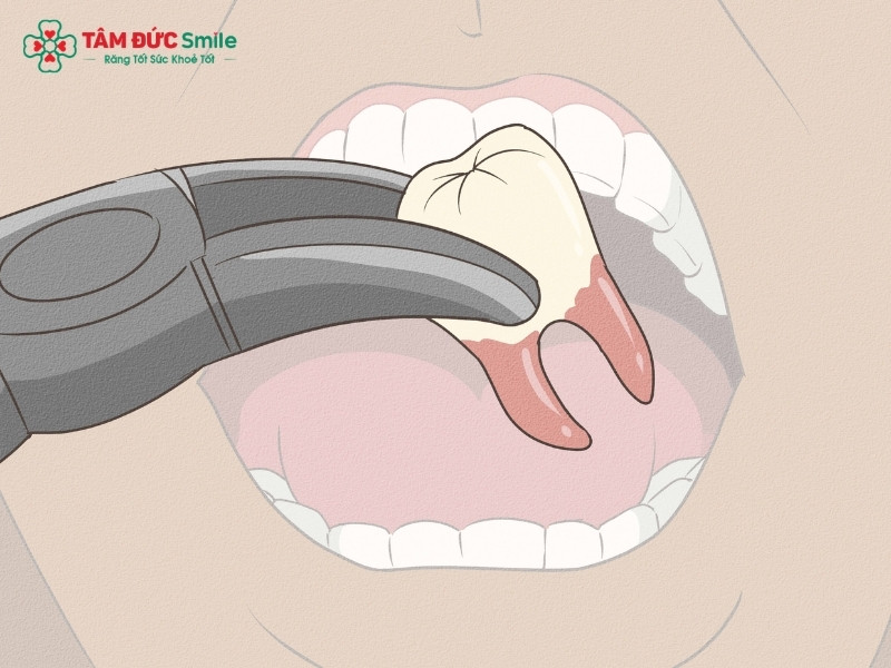 Mọc 4 răng khôn cùng lúc có sao không? Khi nào nên nhổ?