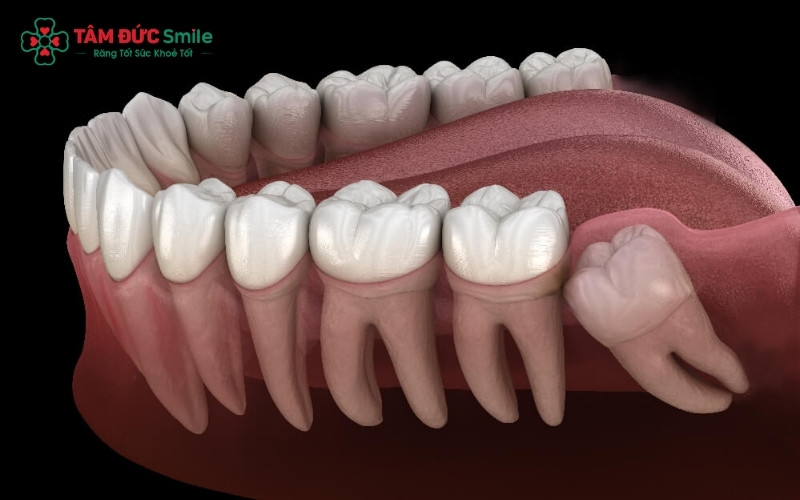 Hệ thống dây thần kinh vùng mặt liên kết chặt chẽ khiến các cơn đau từ răng khôn dễ dàng lan tỏa lên vùng tai và thái dương.