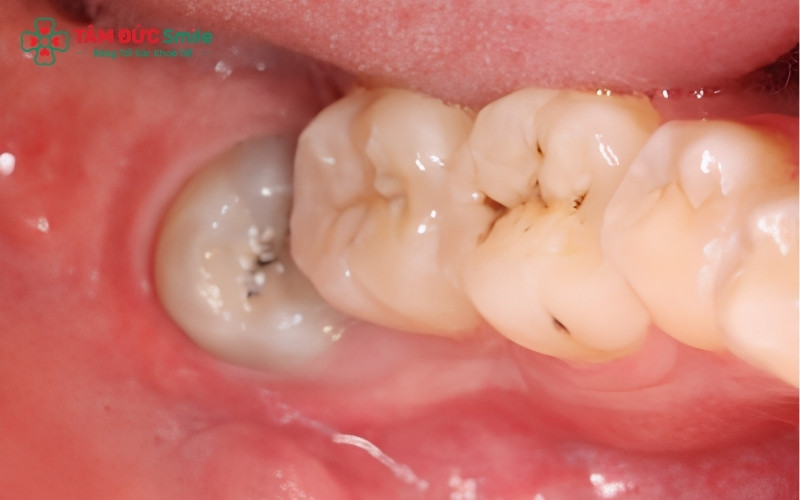 Các sợi thịt gà rất dễ dắt vào vùng nướu đang sưng đỏ, tạo điều kiện cho vi khuẩn phát triển và gây viêm nhiễm.