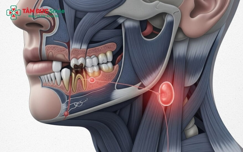 Các tư thế răng khôn mọc lệch, mọc ngầm là nguyên nhân phổ biến dẫn đến viêm nhiễm và nổi hạch vùng cổ.