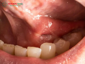 Mọc răng khôn nổi hạch cổ có nguy hiểm không? Cách xử lý