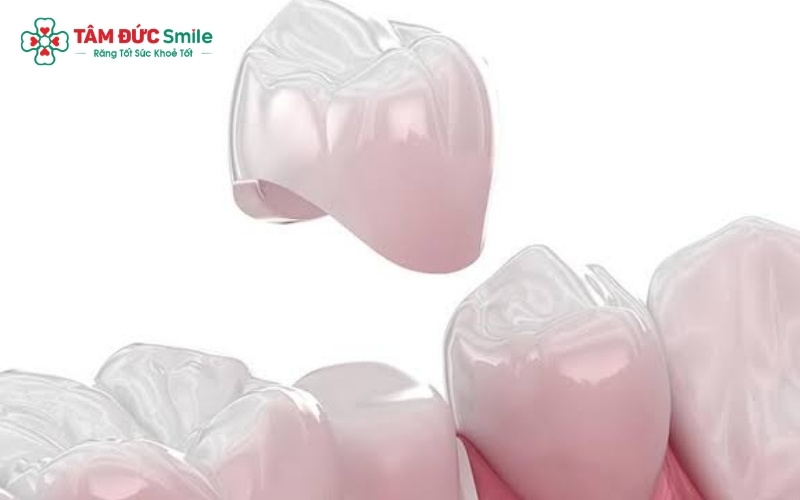 Bọc răng sứ là phương pháp thẩm mỹ nha khoa sử dụng một lớp vỏ bằng sứ