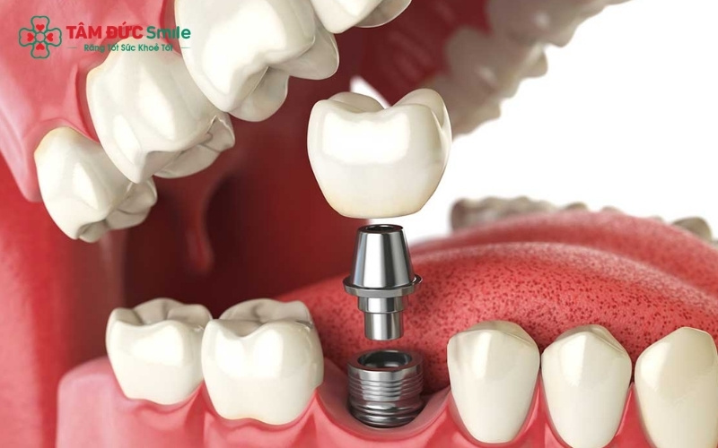 Cấy ghép Implant là kỹ thuật trồng răng giả tiên tiến bằng cách đặt một trụ chân răng nhân tạo