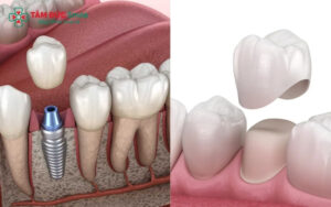 Cấy ghép Implant giúp bảo tồn răng thật tối đa, trong khi cầu răng sứ bắt buộc phải mài nhỏ các răng khỏe mạnh bên cạnh để làm trụ đỡ.