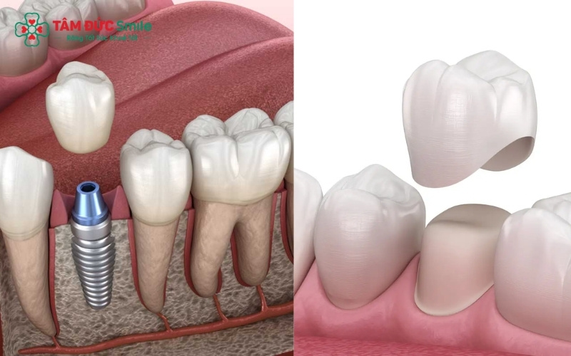 Cấy ghép Implant giúp bảo tồn răng thật tối đa, trong khi cầu răng sứ bắt buộc phải mài nhỏ các răng khỏe mạnh bên cạnh để làm trụ đỡ.