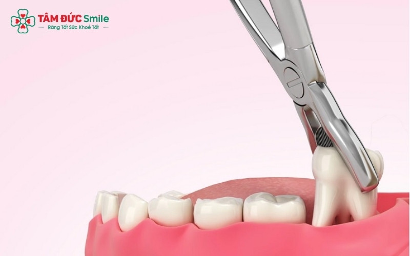 Nhổ 2 răng khôn cùng phía giúp tiết kiệm thời gian và thuận tiện hơn trong việc ăn nhai sau tiểu phẫu.