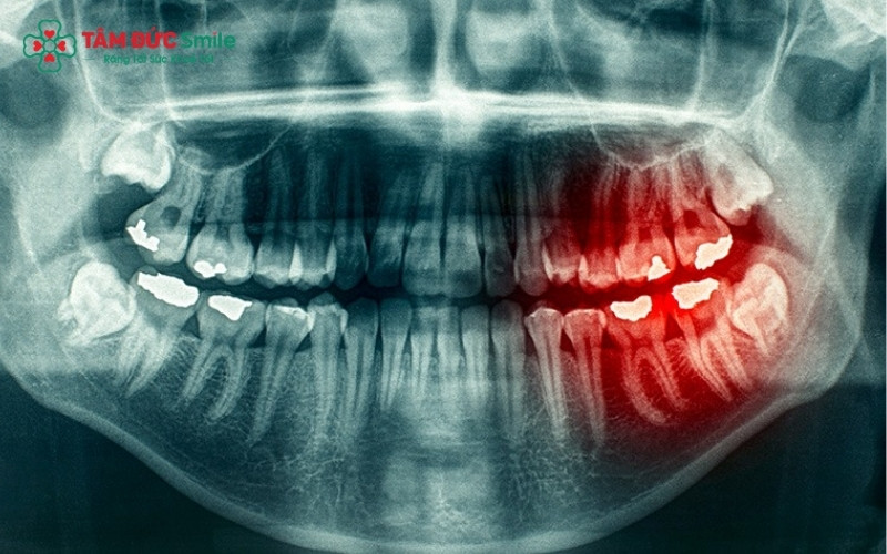 Khám lâm sàng và chụp X-quang giúp bác sĩ xác định lộ trình nhổ răng khôn an toàn cho từng bệnh nhân.
