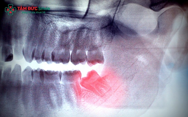 Độ phức tạp của vị trí răng khôn là yếu tố quan trọng quyết định thời gian hồi phục và khoảng cách giữa các lần nhổ