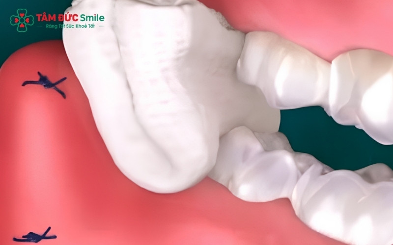 Chăm sóc sau khi nhổ răng khônđúng cách giúp giảm sưng đau, thúc đẩy vết thương nhanh lành.