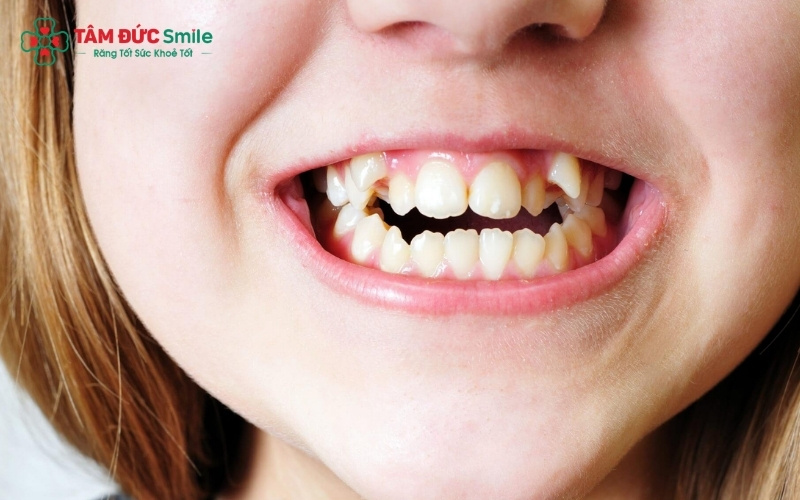 Răng khểnh mọc lệch quá mức tạo ra các "điểm mù" khó vệ sinh, dễ tích tụ mảng bám dẫn đến sâu răng và các bệnh lý về nướu.