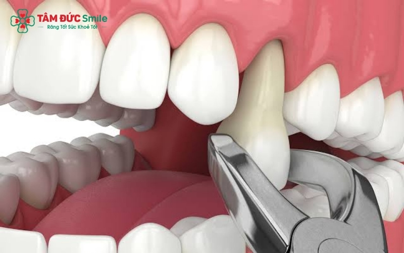 Đánh giá chính xác vị trí chân răng khểnh, đảm bảo quy trình nhổ răng an toàn và không gây ảnh hưởng đến thẩm mỹ khuôn mặt.