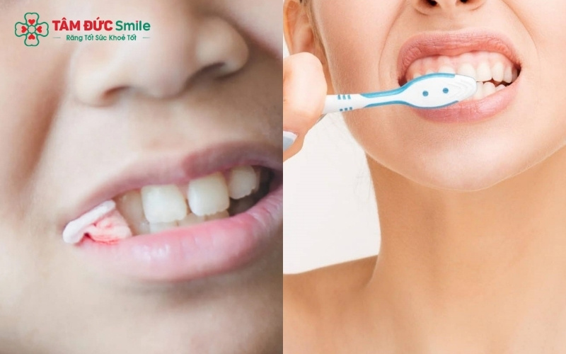 Sau khi nhổ răng khểnh, việc ưu tiên các thực phẩm mềm, nguội và tuân thủ hướng dẫn vệ sinh của bác sĩ là chìa khóa để vết thương mau phục hồi