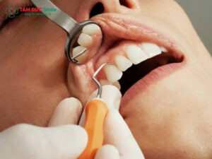 Có nên nhổ răng khểnh không? Lưu ý sau khi nhổ răng khểnh