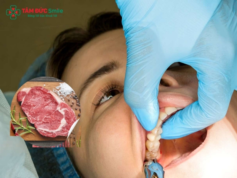 Nhổ răng khôn ăn thịt bò được không? Bao lâu thì ăn được?