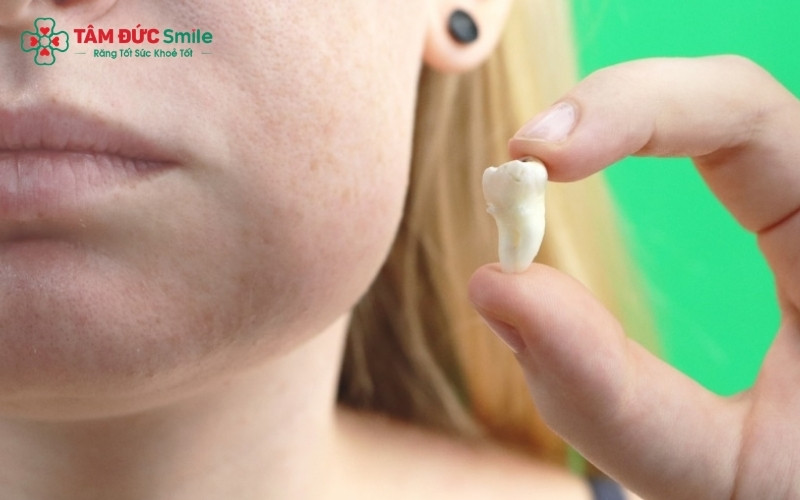 Tình trạng sưng má thường đạt đỉnh điểm vào ngày thứ 2-3 và sẽ giảm dần sau đó.