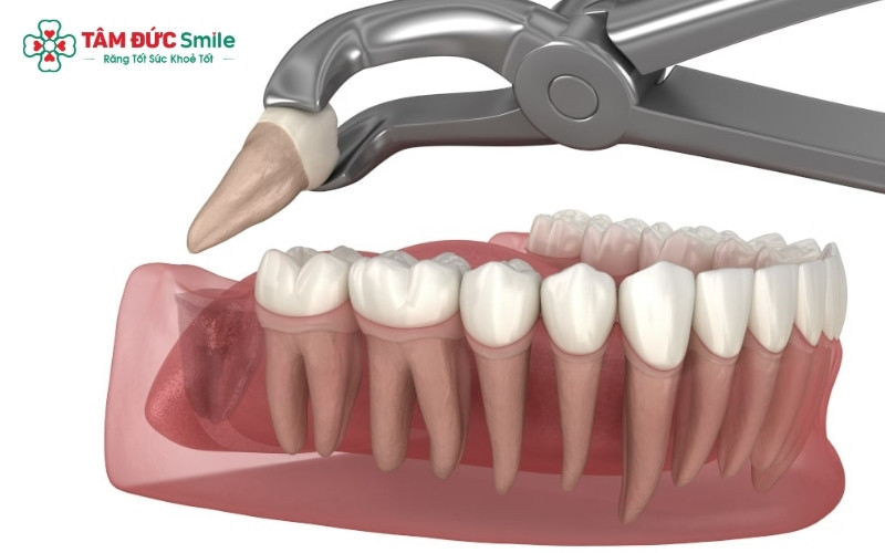 Với kỹ thuật gây tê tại chỗ cho các ca nhổ răng đơn giản, việc nhịn ăn là không cần thiết, thậm chí bệnh nhân cần ăn no để có tâm lý và thể trạng tốt nhất.