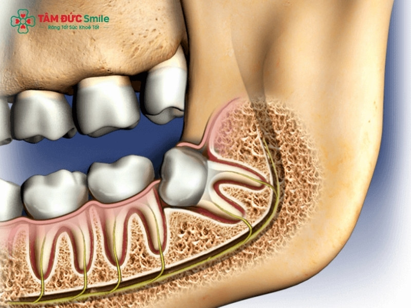 Nhổ răng khôn có cần nhịn ăn sáng? Khi nào nên ăn, khi nào phải nhịn