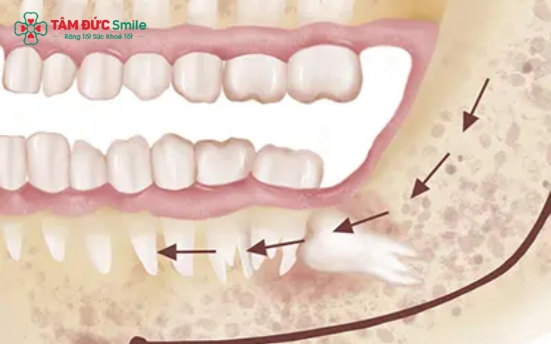 Răng khôn là chiếc răng mọc cuối cùng trên cung hàm và thường không tham gia vào chức năng ăn nhai chính, nên việc trồng lại sau khi nhổ thường là không cần thiết.
