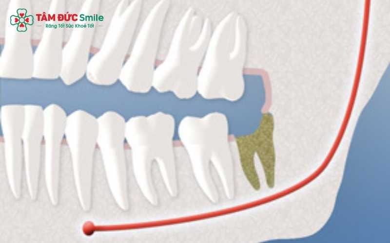 Vì răng số 6 và số 7 đã đảm nhận gần như toàn bộ lực nhai, việc thiếu vắng răng số 8 không gây ảnh hưởng đến khả năng ăn uống hay thẩm mỹ nụ cười.