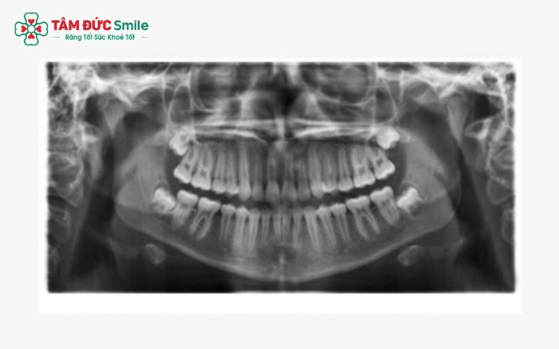 Nhiều người nhầm lẫn răng khôn với răng số 7. Nếu mất răng số 7, bạn bắt buộc phải trồng lại để tránh xô lệch hàm và suy giảm sức nhai.