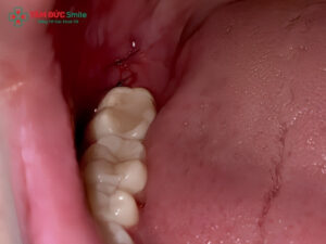 Nhổ răng khôn có cần trồng lại không?