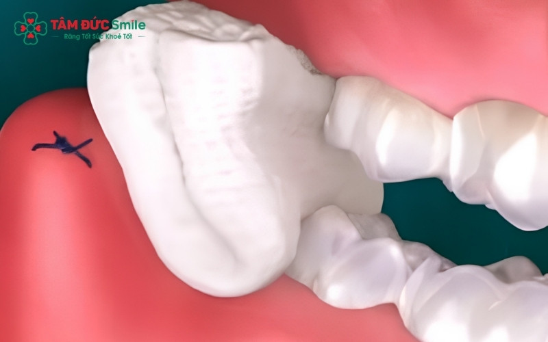 Cắn gạc đúng thời gian bác sĩ hướng dẫn của bác sĩ sẽ giúp vết thương nhổ răng khôn nhanh chóng khép miệng và hồi phục.
