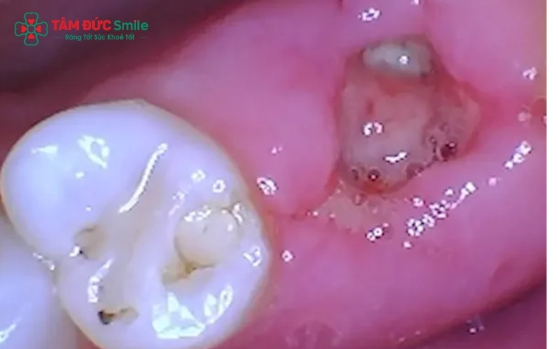 Viêm ổ răng khô hoặc thức ăn mắc kẹt là những nguyên nhân phổ biến nhất khiến vết thương chậm lành và gây đau nhức kéo dài.