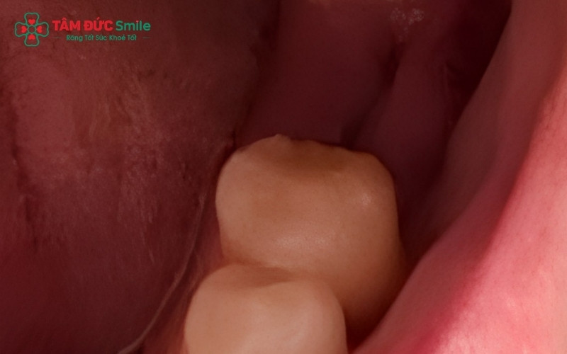 Tiết nhiều nước bọt sau khi nhổ răng khôn là phản ứng tự nhiên của cơ thể để bảo vệ vết thương và thường sẽ thuyên giảm sau 24–48 giờ.