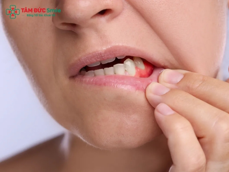 Nhổ răng khôn tiết nhiều nước bọt: Nguyên nhân và cách xử lý