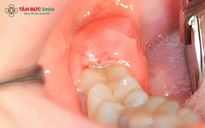 Cấu trúc giải phẫu của răng khôn khiến các mô mềm xung quanh dễ bị kích ứng và sưng nề sau tiểu phẫu.