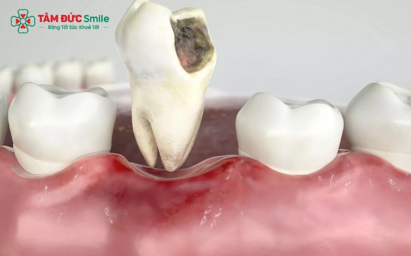 Nếu không có kế hoạch trồng răng lại sớm, việc nhổ răng sâu có thể dẫn đến xô lệch toàn hàm và tiêu xương hàm tại vị trí mất răng