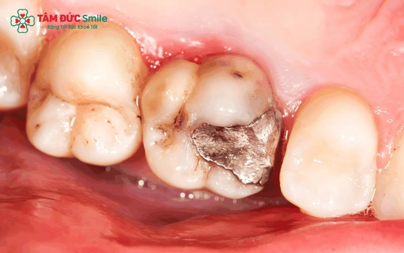 Bác sĩ chỉ chỉ định nhổ răng sâu khi cấu trúc răng đã bị phá hủy quá nặng, không thể phục hồi bằng phương pháp trám hay bọc sứ.