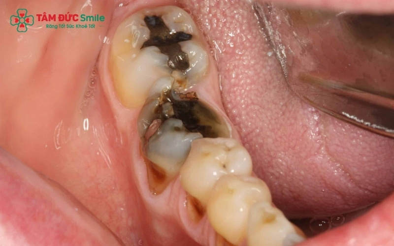 Răng sâu nặng nếu không nhổ bỏ kịp thời sẽ gây áp xe chân răng, viêm xương hàm và đe dọa sức khỏe của các răng lân cận
