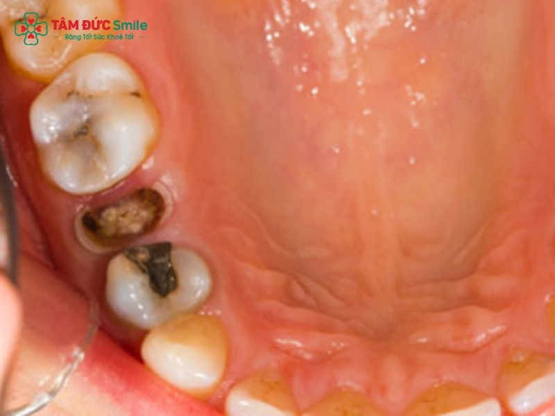 Nhổ răng sâu có ảnh hưởng gì không? Khi nào cần nhổ?