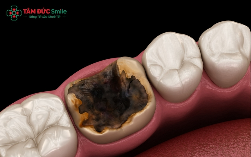 Loại bỏ răng sâu bị hỏng nặng giúp tiêu diệt tận gốc ổ vi khuẩn, giúp bạn lấy lại hơi thở thơm tho và sự tự tin trong giao tiếp.