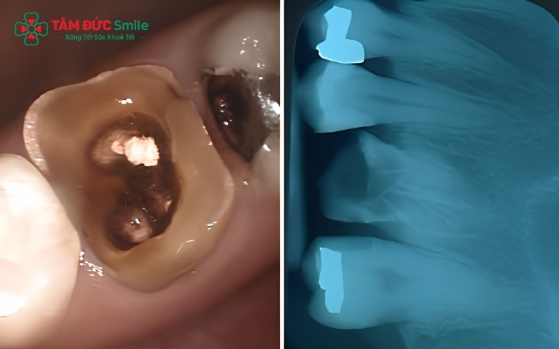 Lỗ sâu là nơi trú ngụ lý tưởng của thức ăn thừa; dưới tác động của vi khuẩn, chúng bị phân hủy và tạo ra mùi hôi đặc trưng
