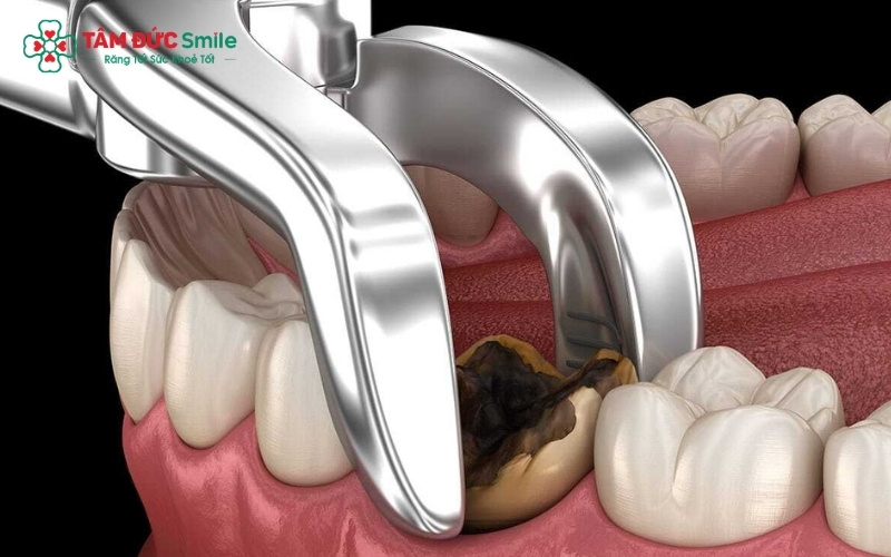 Những chiếc răng sâu vỡ lớn hoặc răng khôn mọc lệch gây nhồi nhét thức ăn thường là "thủ phạm" chính gây hôi miệng kéo dài và cần được nhổ bỏ sớm.