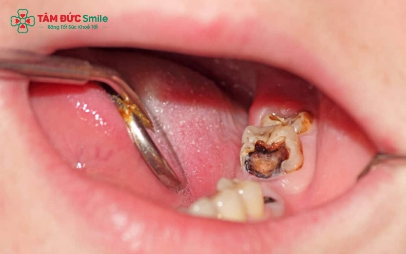 Những trường hợp răng sâu hàm dưới bị vỡ quá lớn, không thể bọc sứ hay điều trị tủy sẽ được chỉ định nhổ bỏ để bảo vệ các răng khỏe mạnh xung quanh
