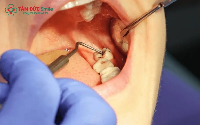 Bác sĩ xác định chính xác vị trí chân răng và dây thần kinh, đảm bảo quá trình nhổ răng diễn ra an toàn, không gây biến chứng.