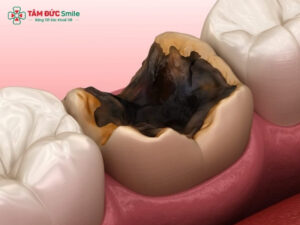 Khi nào cần nhổ răng sâu hàm dưới? Những lưu ý sau khi nhổ răng sâu hàm dưới