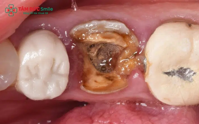 Răng số 6 là răng hàm lớn đóng vai trò chủ lực trong việc nghiền nát thức ăn; bác sĩ luôn ưu tiên các biện pháp bảo tồn thay vì nhổ bỏ.