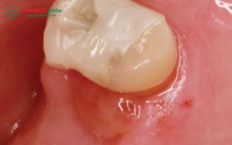 Công nghệ nhổ răng bằng sóng siêu âm giúp tách răng ra khỏi tổ chức quanh răng một cách nhẹ nhàng, hạn chế chảy máu và giảm thiểu đau nhức.