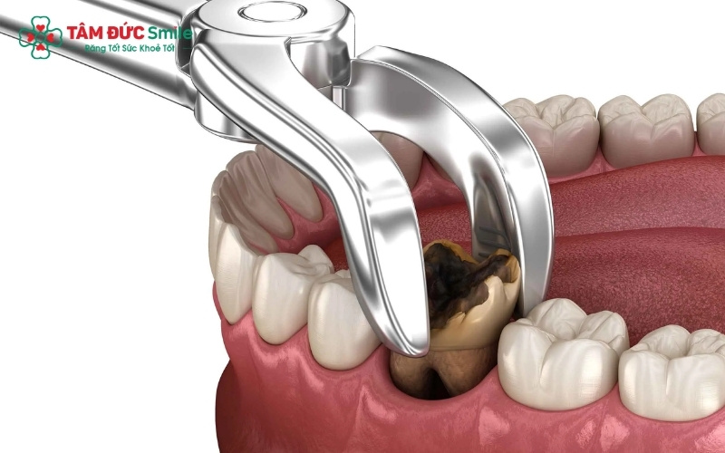 Vị trí chân răng số 6 và khoảng cách với dây thần kinh, đảm bảo quá trình nhổ răng không gây biến chứng.