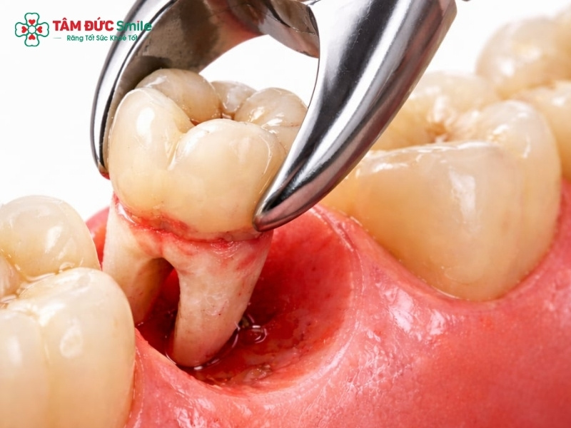 Nhổ răng sâu số 6 hàm dưới có nguy hiểm không? Khi nào nên nhổ?