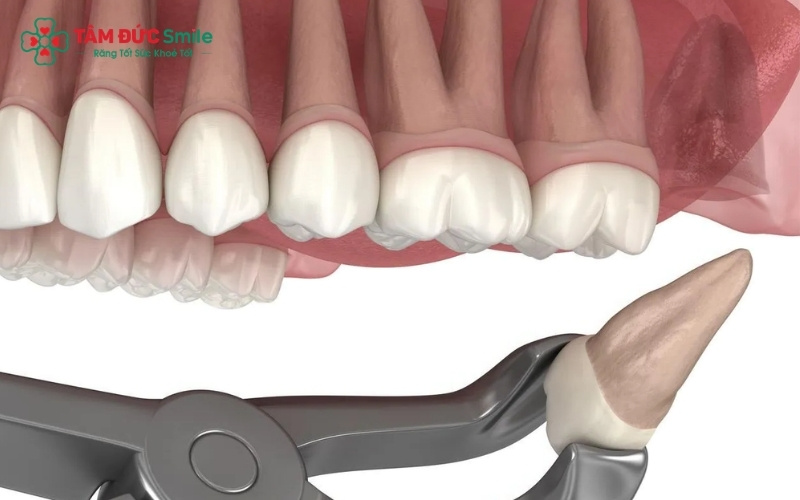 Việc ứng dụng công nghệ sóng siêu âm Piezotome kết hợp kỹ thuật gây tê hiện đại giúp việc nhổ răng sâu số 8 hàm trên trở nên nhẹ nhàng, ít sưng đau