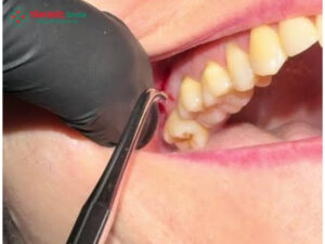 Nhổ răng sâu số 8 hàm trên có nguy hiểm không?