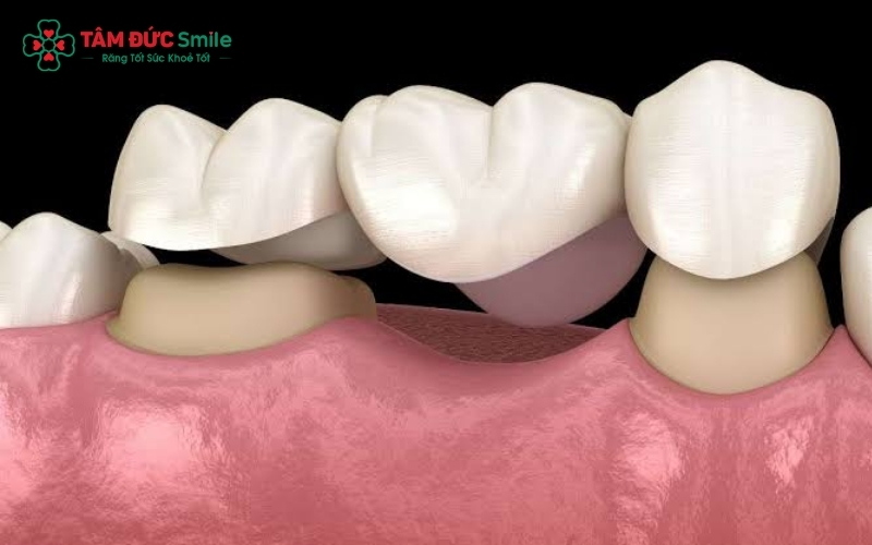 Nhờ kỹ thuật gây tê hiện đại, quá trình mài răng làm cầu sứ diễn ra hoàn toàn nhẹ nhàng, giúp bệnh nhân cảm thấy thoải mái và không đau đớn.